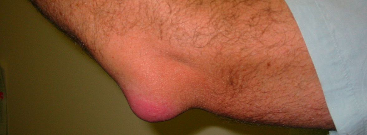 Bursitis codo PhysioEliteSport