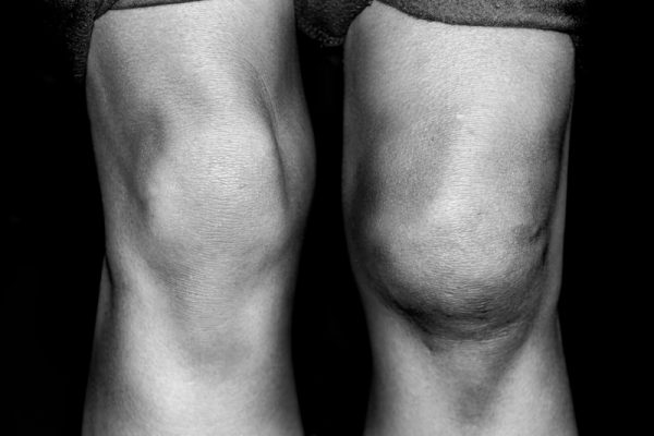 Bursitis rodilla PhysioEliteSport